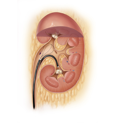 nefrolithiasi