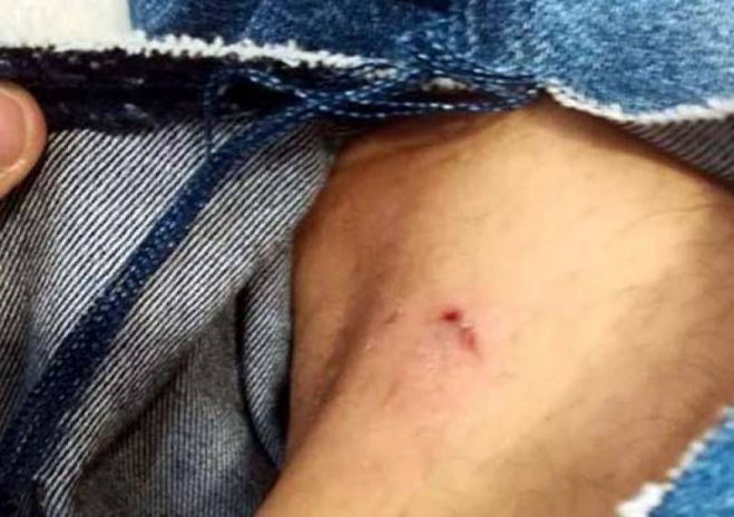 Καλαμάτα | Αδέσποτα σκυλιά επιτέθηκαν σε εργαζόμενο φοιτητή