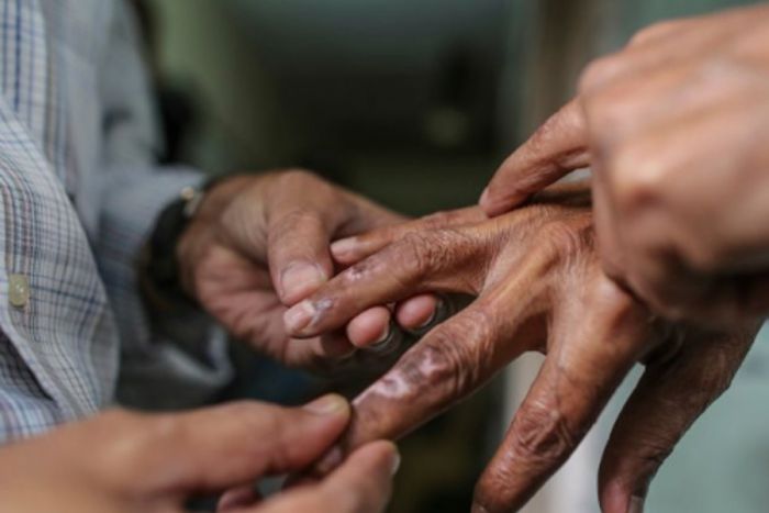 Καθησυχαστικός ο ΕΟΔΥ για το κρούσμα λέπρας: "Ιάσιμη νόσος, δεν είναι πολύ μεταδοτική"
