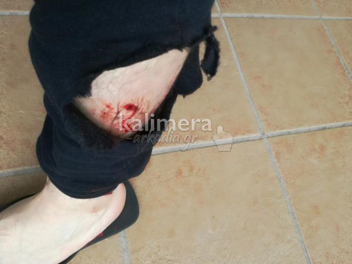 Τρίπολη | Πολίτης καταγγέλλει επίθεση από δύο σκυλιά – Δείτε εικόνες