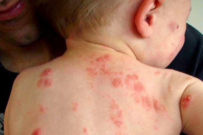Υγεία | 79 κρούσματα ιλαράς στην Πελοπόννησο – Κανένα στην Αρκαδία!