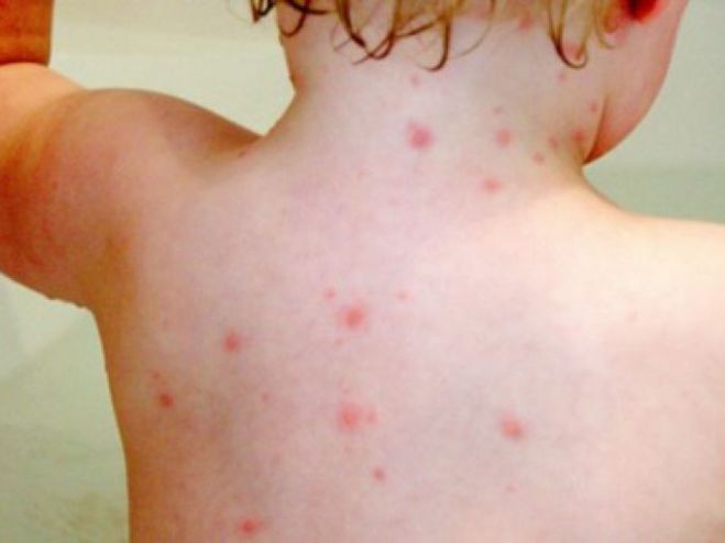 Υγεία - Έξαρση της ιλαράς | Τα παιδιά πρέπει να εμβολιάζονται από την ηλικία των 12 μηνών