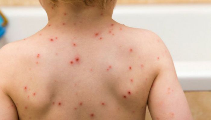 Υγεία | Μόνο ένα κρούσμα ιλαράς έχει δηλωθεί στην Αρκαδία