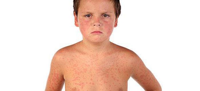 Υγεία | Τουλάχιστον 8 τα κρούσματα ιλαράς στην Αργολίδα – Απαραίτητος ο άμεσος εμβολιασμός