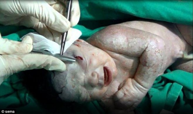 Βρέφος στη Συρία γεννήθηκε με θραύσμα οβίδας στο κεφάλι! (vd)