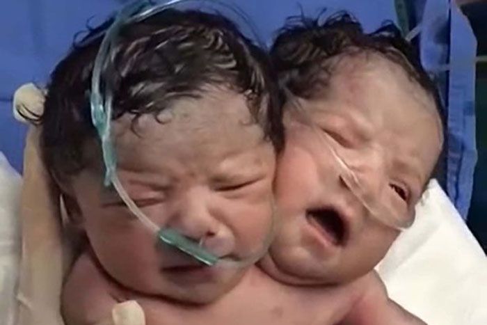 Μεξικό: Γεννήθηκε μωρό με δύο κεφάλια (vd)