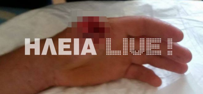 Άλογο έφαγε το δάχτυλο του ιδιοκτήτη του στον Πύργο ...