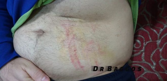 Διακοπή αγώνα στην Ηλεία | Διαιτητής χτυπήθηκε στην κοιλιά από ποδοσφαιριστή!