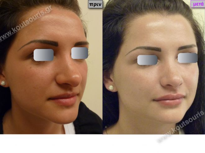 &Tau;&omicron; &Upsilon;&alpha;&lambda;&omicron;&upsilon;&rho;&omicron;&nu;&iota;&kappa;ό &omicron;&xi;ύ &mu;&pi;&omicron;&rho;&epsilon;ί &nu;&alpha; &sigma;&epsilon; &kappa;ά&nu;&epsilon;&iota; &pi;&omicron;&lambda;ύ &nu;&epsilon;ό&tau;&epsilon;&rho;&eta; &mu;έ&sigma;&alpha; &sigma;&epsilon; &lambda;ί&gamma;&alpha; &lambda;&epsilon;&pi;&tau;ά