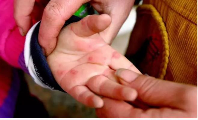 ''&Sigma;&epsilon; &laquo;&kappa;&alpha;&rho;&alpha;&nu;&tau;ί&nu;&alpha;&raquo; &pi;&alpha;&iota;&delta;&iota;ά &kappa;&alpha;&iota; &gamma;&omicron;&nu;&epsilon;ί&sigmaf; &mu;&epsilon; &sigma;&upsilon;&mu;&pi;&tau;ώ&mu;&alpha;&tau;&alpha; &kappa;&omicron;&xi;ά&kappa;&iota;'' &sigma;&upsilon;&nu;&iota;&sigma;&tau;ά &omicron; &kappa;&alpha;&theta;&eta;&gamma;&eta;&tau;ή&sigmaf; &Epsilon;&pi;&iota;&delta;&eta;&mu;&iota;&omicron;&lambda;&omicron;&gamma;ί&alpha;&sigmaf;, &Delta;&eta;&mu;ή&tau;&rho;&eta;&sigmaf; &Pi;&alpha;&rho;&alpha;&sigma;&kappa;&epsilon;&upsilon;ή&sigmaf;