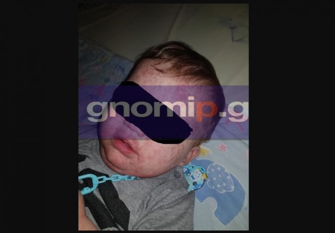 Πάτρα | Βρέφος πήγε στο Καραμανδάνειο Νοσοκομείο με ωτίτιδα και κόλλησε ιλαρά