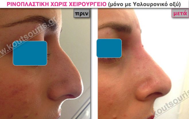 Είναι αλήθεια! Ρινοπλαστική χωρίς νυστέρι!