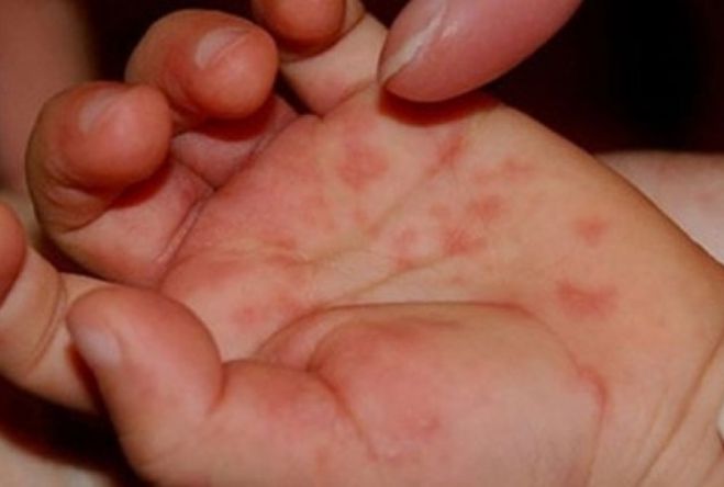Αυξάνονται τα περιστατικά Coxsackie σε παιδιά στην Ελλάδα