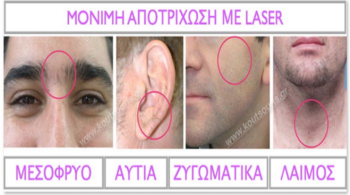 Ανεπιθύμητη τριχοφυΐα στους άνδρες; Οριστική λύση με laser δίνει ο Μιχάλης Κουτσούρης! (εικόνες)