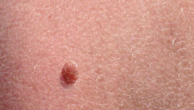 Σπίλοι («Ελιές») του δέρματος: Πρόληψη και εκτίμηση του κινδύνου εξέλιξης σε καρκίνο του δέρματος