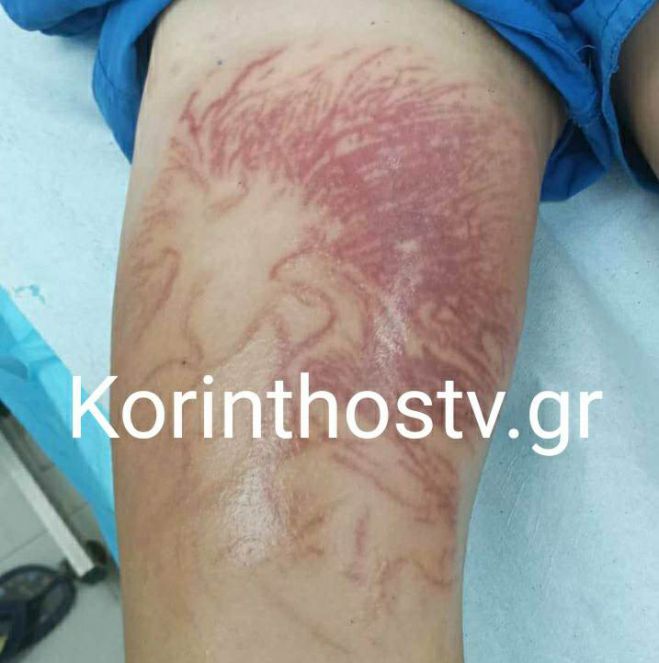 Στο νοσοκομείο 9χρονος που δέχτηκε τσίμπημα απο θαλάσσια ανεμώνη στο Καλαμάκι Κορινθίας
