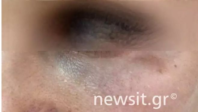 &Theta;έ&mu;&eta;&sigmaf; &Alpha;&delta;&alpha;&mu;&alpha;&nu;&tau;ί&delta;&eta;&sigmaf; | &Tau;&alpha; &chi;&tau;&upsilon;&pi;ή&mu;&alpha;&tau;&alpha; &sigma;&tau;&omicron; &pi;&rho;ό&sigma;&omega;&pi;&omicron; &tau;&eta;&sigmaf; &pi;&rho;ώ&eta;&nu; &sigma;&upsilon;&nu;&tau;&rho;ό&phi;&omicron;&upsilon; &tau;&omicron;&upsilon;