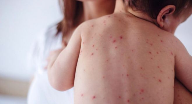 Υγεία | Μόνο ένα κρούσματα ιλαράς στην Αρκαδία - 144 κρούσματα σε γειτονικούς νομούς