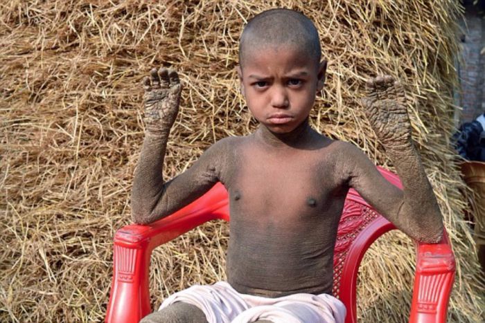 Μπαγκλαντές: Αυτό το αγόρι μετατρέπεται σε πέτρα, λόγω σπάνιας ασθένειας! (εικόνες)