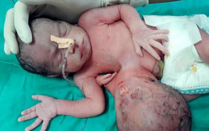 Μωρό γεννήθηκε με δεύτερο κεφάλι, κολλημένο στο στομάχι του (εικόνες)