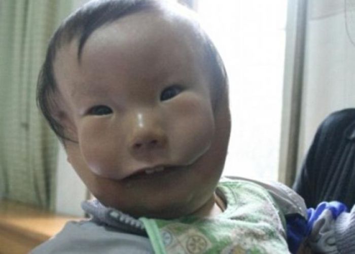 Ραγίζει καρδιές το αγόρι - μάσκα: Φαίνεται να έχει δυο πρόσωπα από γενετική διαταραχή