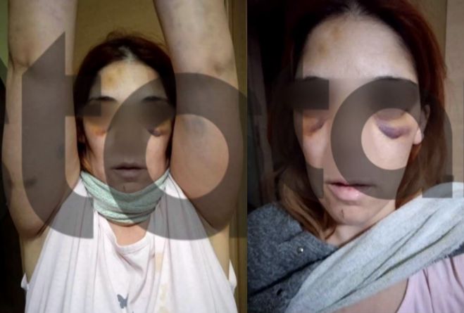 Σοκάρουν οι εικόνες με τη μελανιασμένη γυναίκα που κακοποιήθηκε στο Άργος