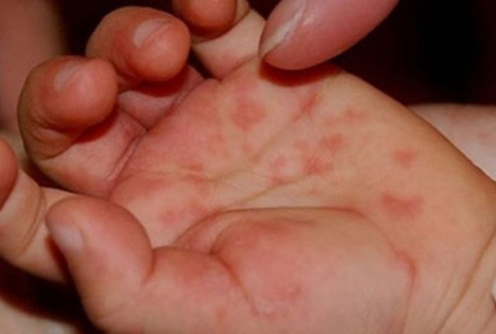 Συνολικά  41 παιδιά με κλινική εικόνα coxsackie έχουν καταγραφεί στην περιοχή της Λάρισας