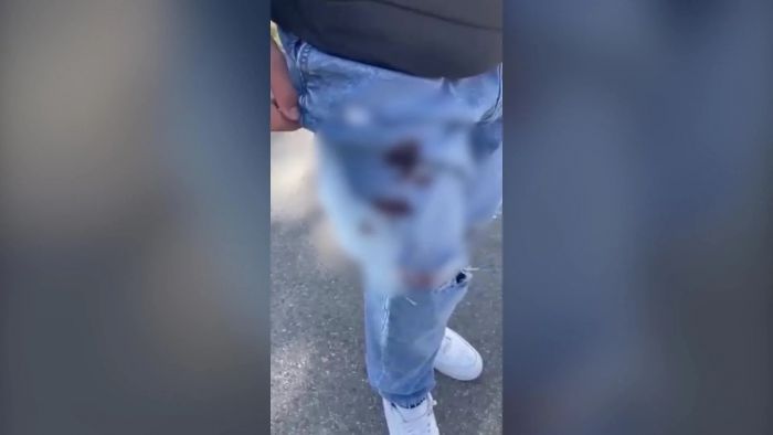 &Alpha;&iota;&mu;&alpha;&tau;&eta;&rho;ό &epsilon;&pi;&epsilon;&iota;&sigma;ό&delta;&iota;&omicron; &sigma;&tau;&eta; &Mu;&epsilon;&sigma;&sigma;ή&nu;&eta; | &Beta;ί&nu;&tau;&epsilon;&omicron; &alpha;&pi;ό &tau;&omicron;&nu; &tau;&rho;&alpha;&upsilon;&mu;&alpha;&tau;&iota;&sigma;&mu;ό 14&chi;&rho;&omicron;&nu;&omicron;&upsilon; &mu;&epsilon; &sigma;&omicron;&upsilon;&gamma;&iota;ά &alpha;&pi;ό &sigma;&upsilon;&mu;&mu;&alpha;&theta;&eta;&tau;ή &tau;&omicron;&upsilon;