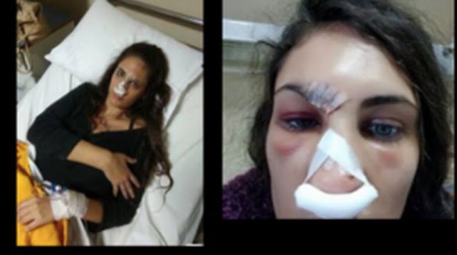 Μυστηριώδες ατύχημα του μοντέλου Ναστάζια Μητροπούλου- Νοσηλεύεται στο νοσοκομείο Ναυπλίου