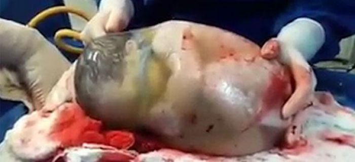 Ένα συγκλονιστικό βίντεο: Μωρό γεννιέται στον αμνιακό σάκο!