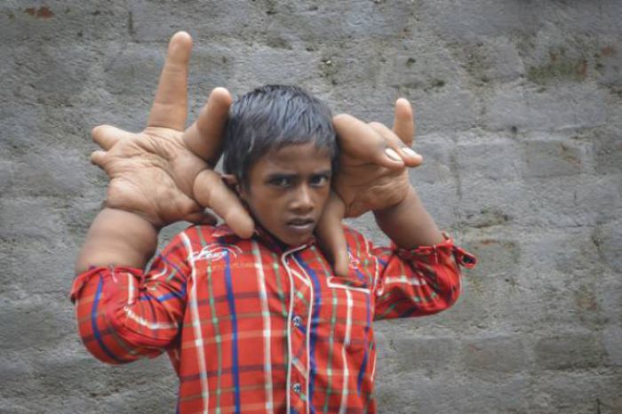 Από σπάνια πάθηση πάσχει ο 8χρονος με τα γιγαντιαία χέρια! (vd)