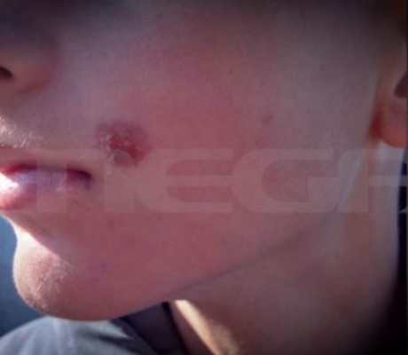 Άγριο bullying | Σοκάρει η επίθεση με τσιγάρο σε 14χρονο παιδί στην Πέλλα (vd)
