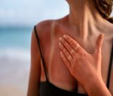 After Sun & ηλιακό έγκαυμα | Τα πάντα για την φροντίδα και την επούλωση